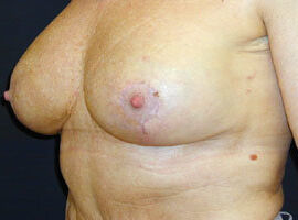 Bruststraffung Foto Beispiel Patientin