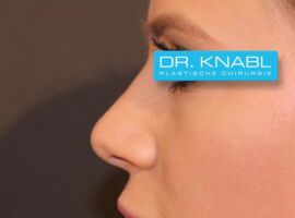 Nase korrigiert von Dr. Knabl